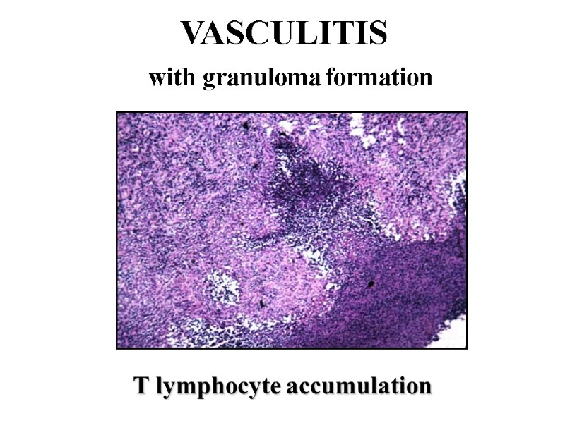 VASCULITIS   with granuloma formation        T